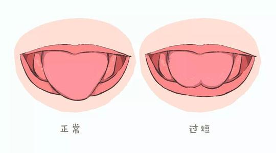 舌系帶短